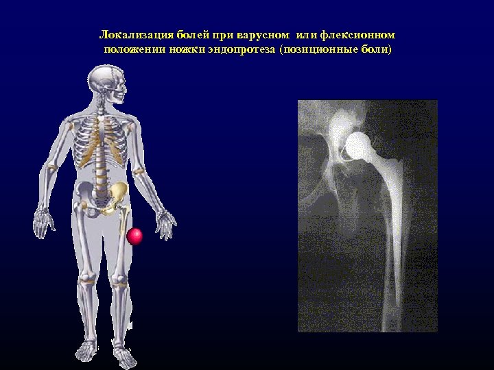 Локализация болей при варусном или флексионном положении ножки эндопротеза (позиционные боли) 