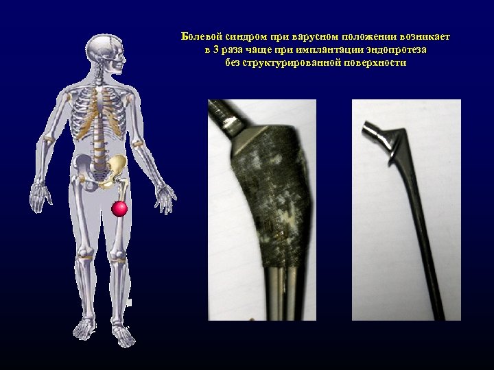 Болевой синдром при варусном положении возникает в 3 раза чаще при имплантации эндопротеза без