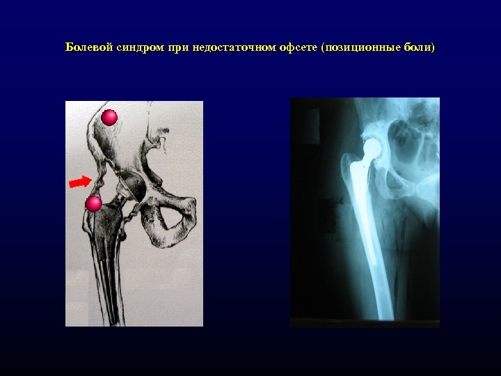 Болевой синдром при недостаточном офсете (позиционные боли) 