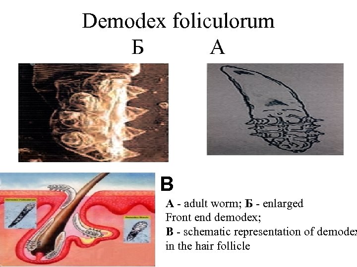 Demodex foliculorum Б А В A adult worm; Б enlarged Front end demodex; B