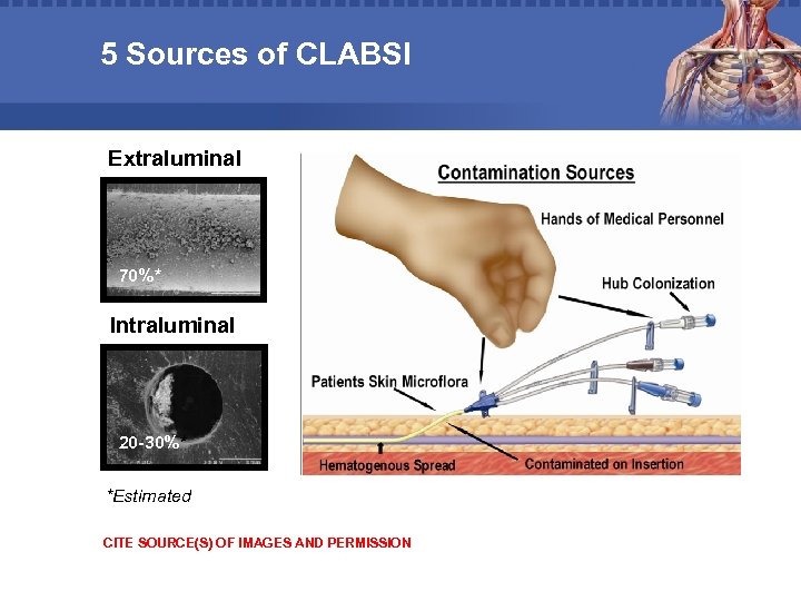 5 Sources of CLABSI Extraluminal 70%* Intraluminal 20 -30%* *Estimated CITE SOURCE(S) OF IMAGES