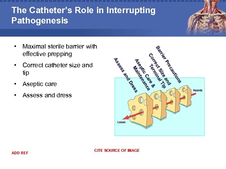 The Catheter’s Role in Interrupting Pathogenesis • Maximal sterile barrier with effective prepping •