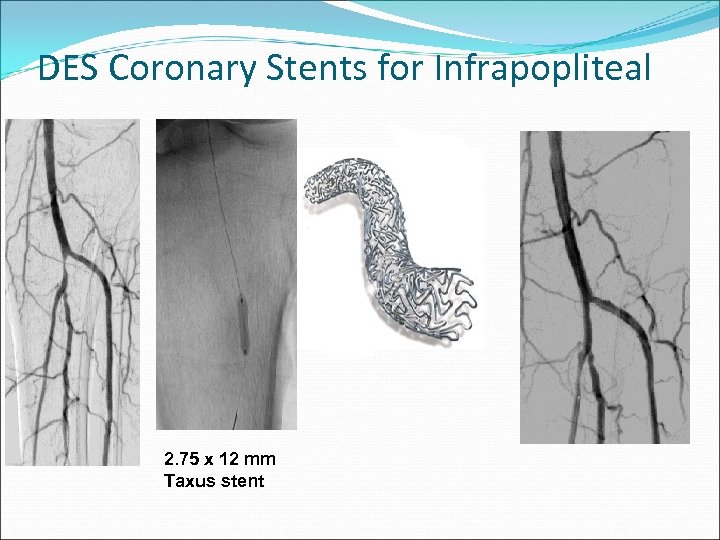 DES Coronary Stents for Infrapopliteal 2. 75 x 12 mm Taxus stent 