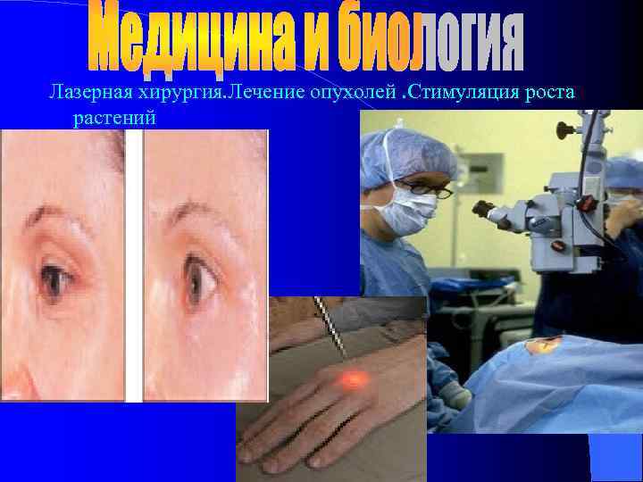 Лазерная хирургия. Лечение опухолей. Стимуляция роста растений 