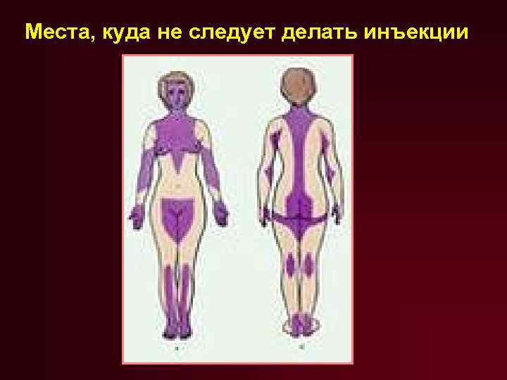 Места, куда не следует делать инъекции 