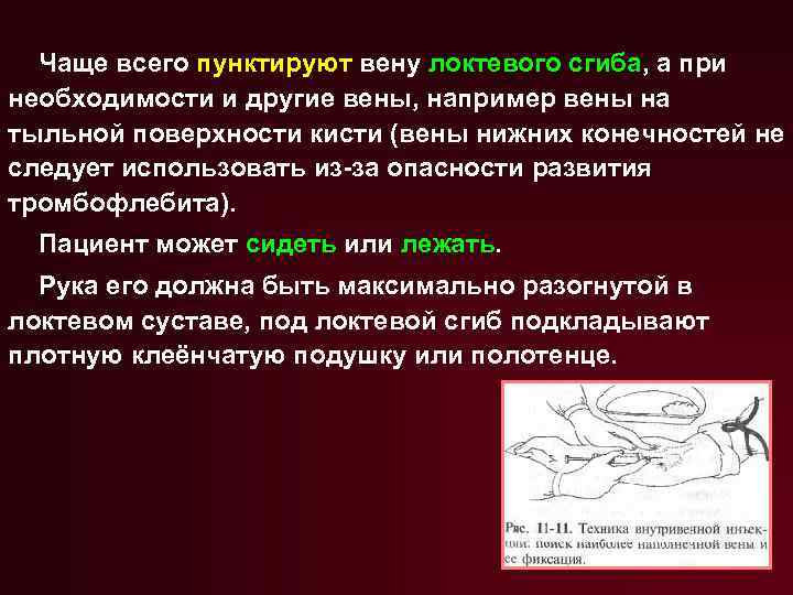 Чаще всего пунктируют вену локтевого сгиба, а при необходимости и другие вены, например вены