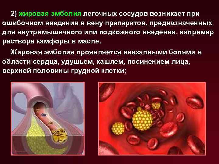 2) жировая эмболия легочных сосудов возникает при ошибочном введении в вену препаратов, предназначенных для