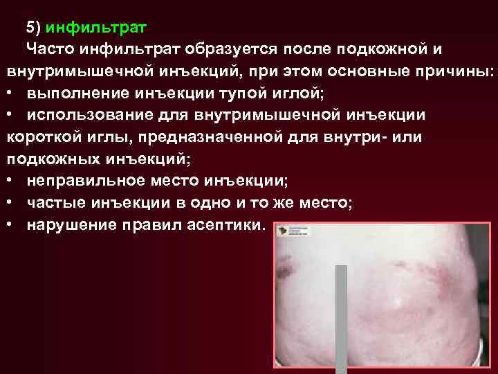 5) инфильтрат Часто инфильтрат образуется после подкожной и внутримышечной инъекций, при этом основные причины: