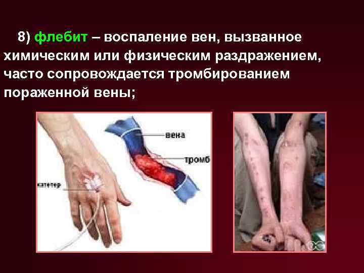8) флебит – воспаление вен, вызванное химическим или физическим раздражением, часто сопровождается тромбированием пораженной