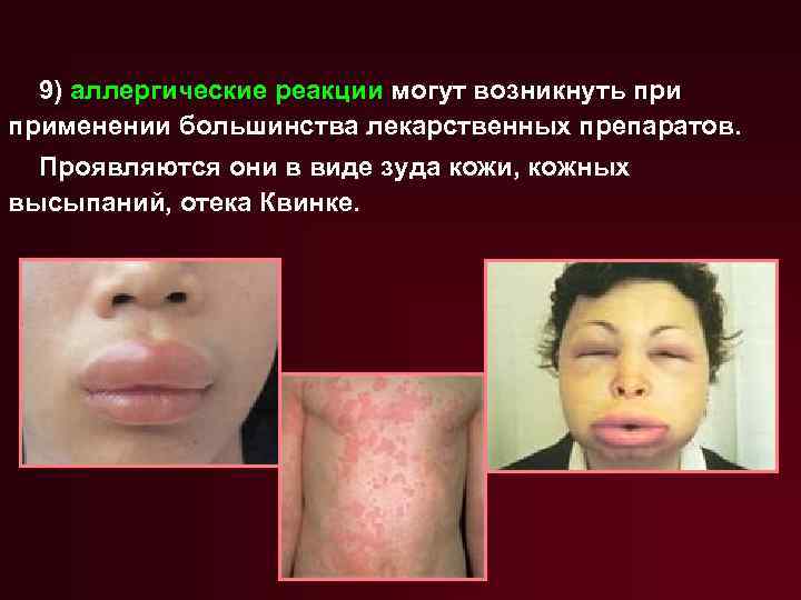 9) аллергические реакции могут возникнуть применении большинства лекарственных препаратов. Проявляются они в виде зуда