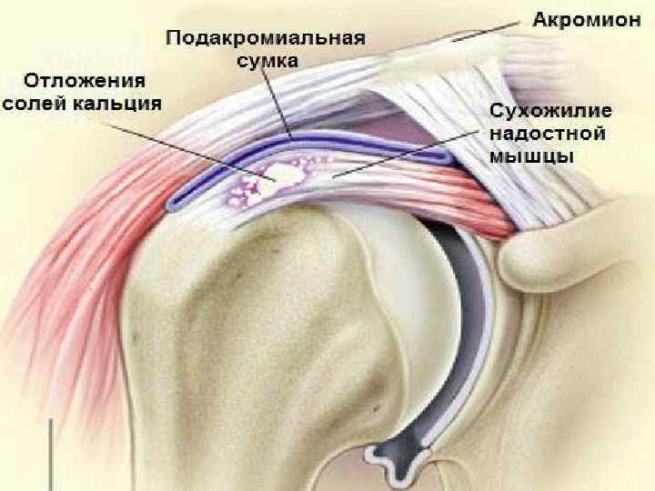 Сухожилие надостной мышцы фото