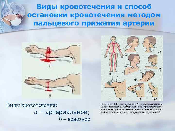 Виды кровотечения и способ остановки кровотечения методом пальцевого прижатия артерии Виды кровотечения: а –
