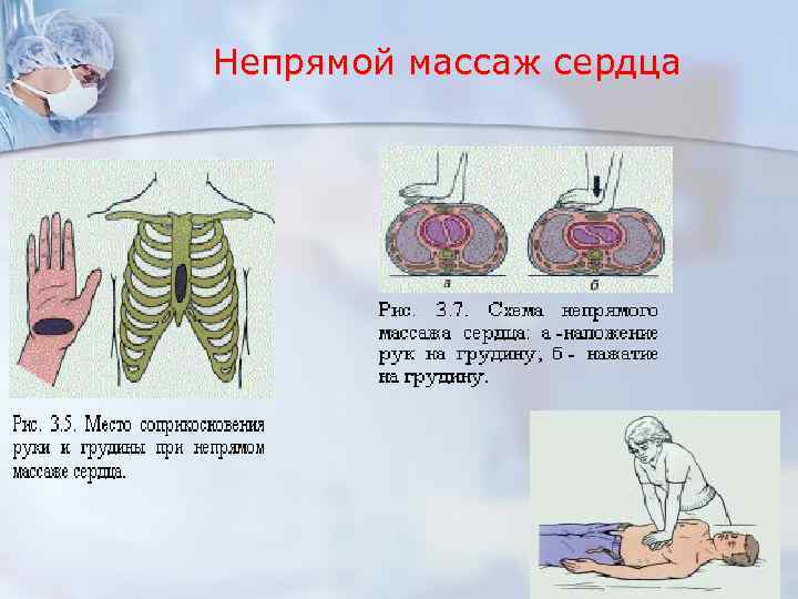 Непрямой массаж сердца 
