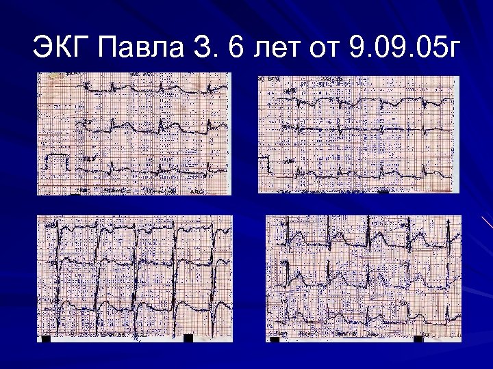 ЭКГ Павла З. 6 лет от 9. 05 г 