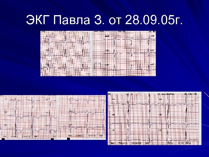 ЭКГ Павла З. от 28. 09. 05 г. 