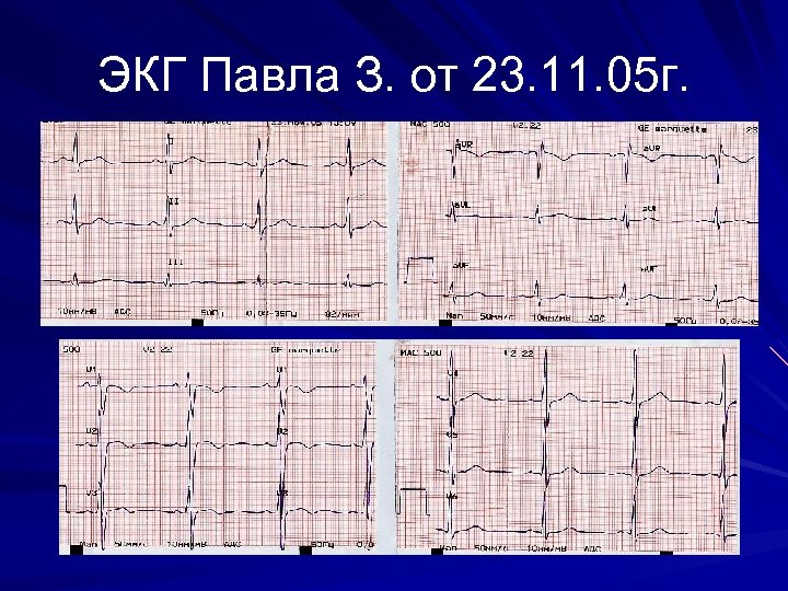 ЭКГ Павла З. от 23. 11. 05 г. 