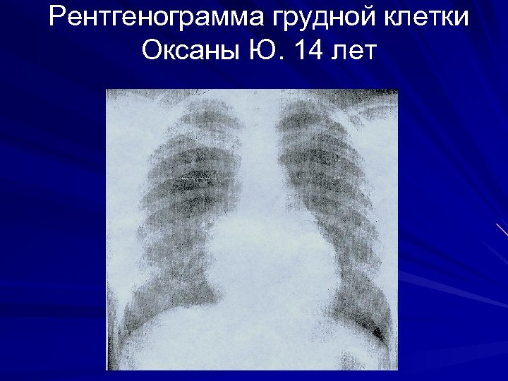 Рентгенограмма грудной клетки Оксаны Ю. 14 лет 