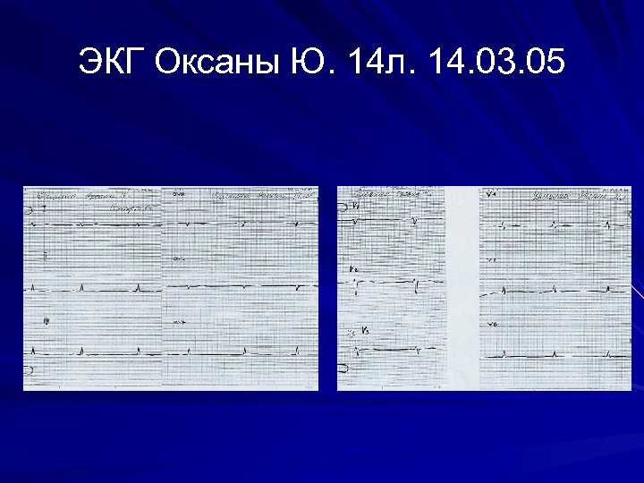 ЭКГ Оксаны Ю. 14 л. 14. 03. 05 