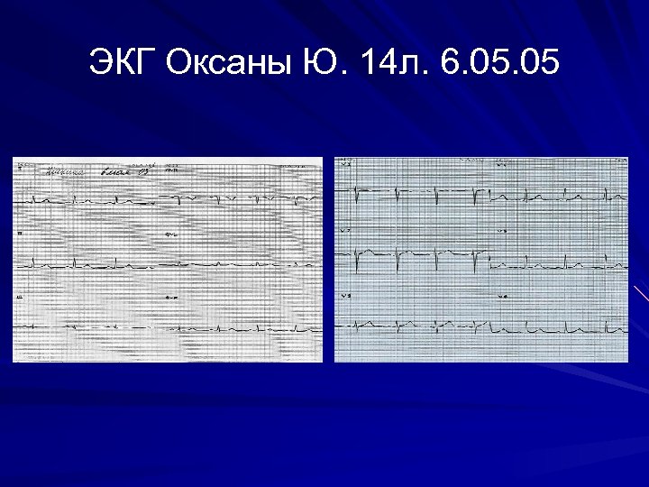 ЭКГ Оксаны Ю. 14 л. 6. 05 