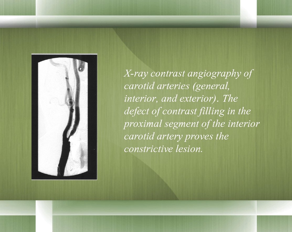 X-ray contrast angiography of carotid arteries (general, interior, and exterior). The defect of contrast