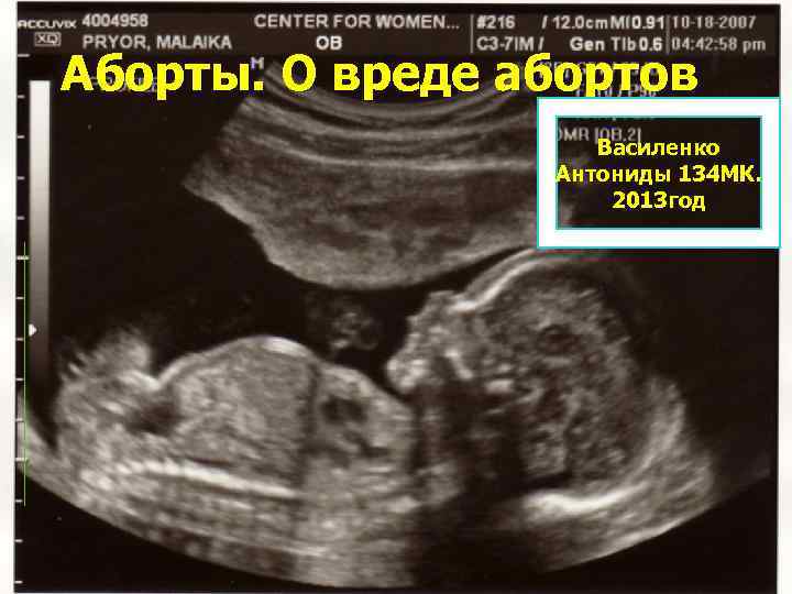 Аборты. О вреде абортов Василенко Антониды 134 МК. 2013 год 