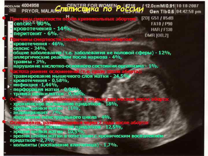  • • • Статистика по России Причины смертности после криминальных абортов: - сепсис