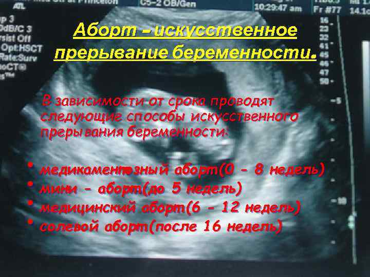 Через сколько забеременели после медикаментозного. Прерывание беременности. Прерывание беременности на 8 неделе. 5 Недель беременности медикаментозный аборт. Медикаментозный аборт на 6 неделе беременности.