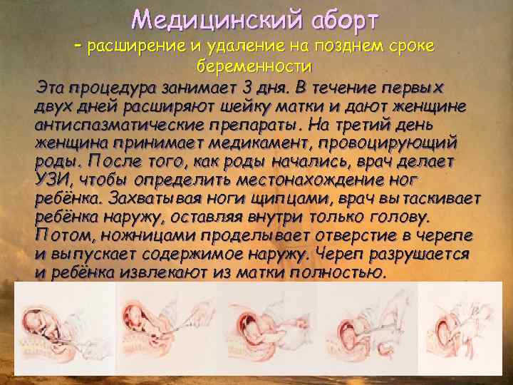 Медицинский аборт – расширение и удаление на позднем сроке беременности Эта процедура занимает 3