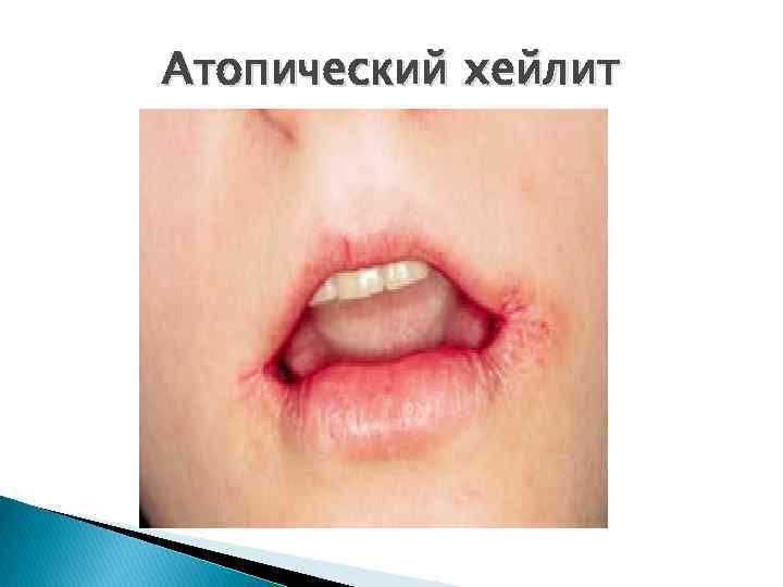 Атопический хейлит 