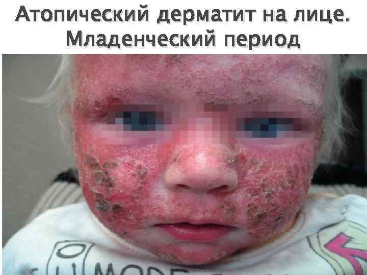 Атопический дерматит на лице. Младенческий период 