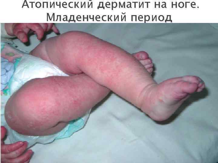  Атопический дерматит на ноге. Младенческий период 