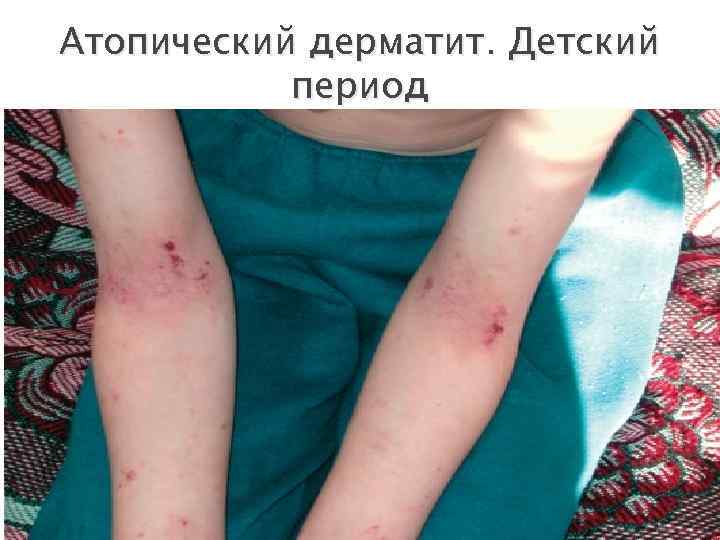 Атопический дерматит. Детский период 