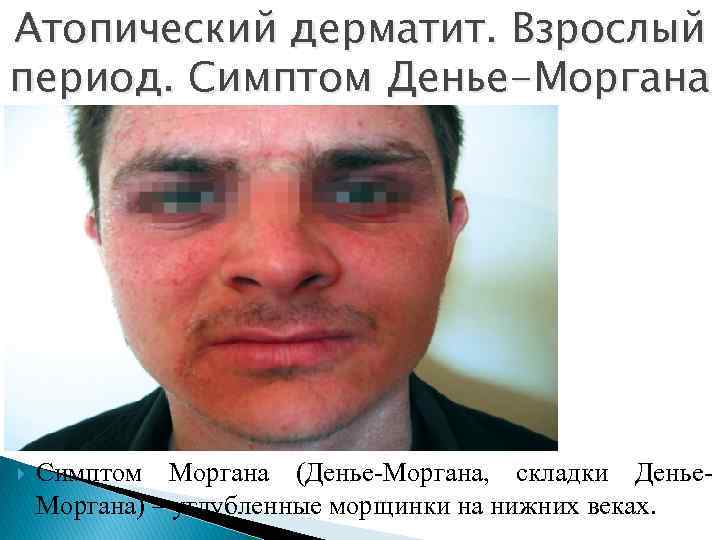 Атопический дерматит. Взрослый период. Симптом Денье-Моргана Симптом Моргана (Денье Моргана, складки Денье Моргана) –