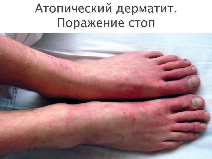 Атопический дерматит. Поражение стоп 