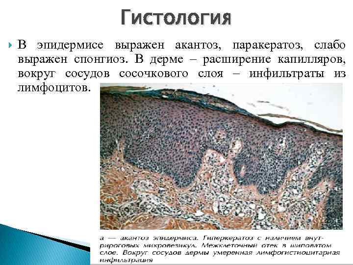 Гистология В эпидермисе выражен акантоз, паракератоз, слабо выражен спонгиоз. В дерме – расширение капилляров,