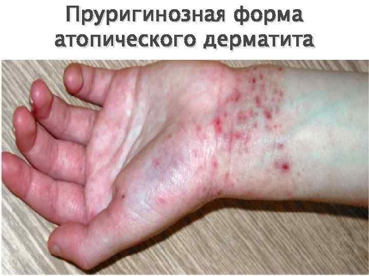 Пруригинозная форма атопического дерматита 