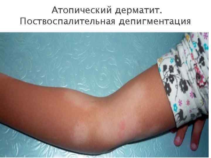  Атопический дерматит. Поствоспалительная депигментация 