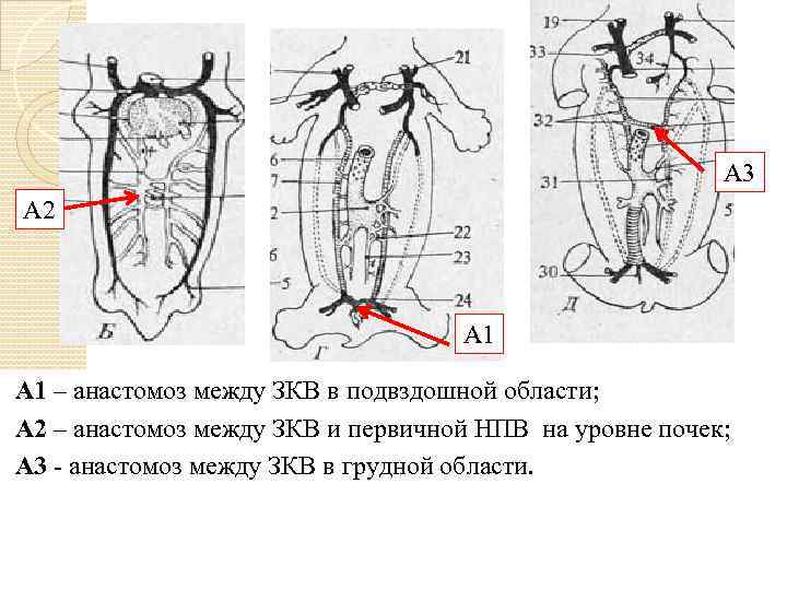 А 3 А 2 А 1 – анастомоз между ЗКВ в подвздошной области; A