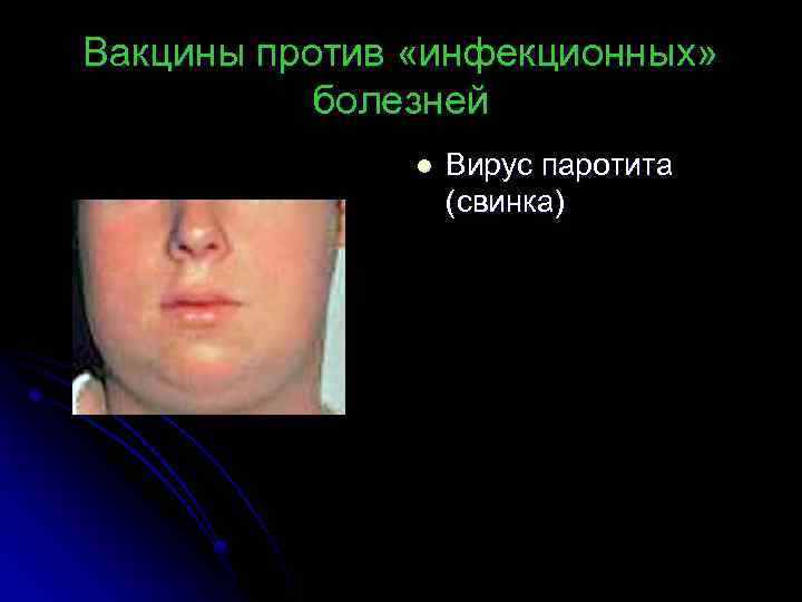 Последствия прививки паротит. Свинка эпидемический паротит. Свинка инфекционное заболевание. Прививка от эпидемического паротита. Свинка болезнь симптомы у детей.