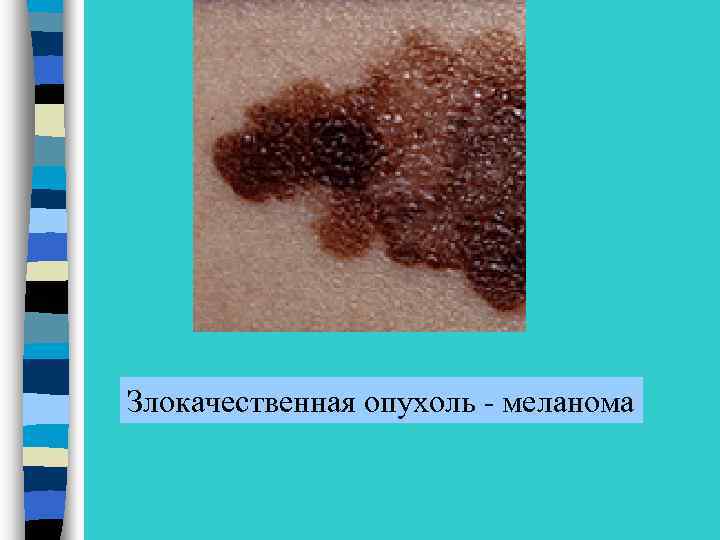 Злокачественная опухоль - меланома 
