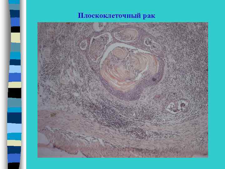Плоскоклеточный рак 