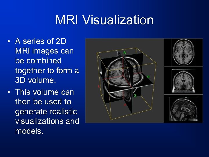 MRI Visualization • A series of 2 D MRI images can be combined together
