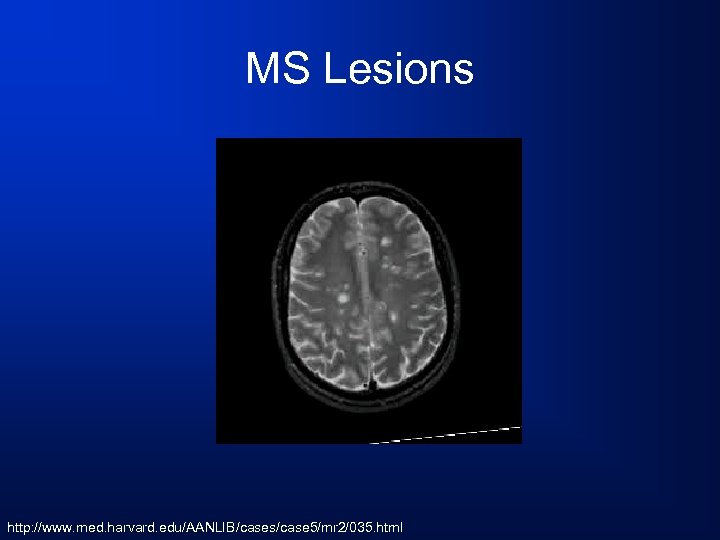 MS Lesions http: //www. med. harvard. edu/AANLIB/cases/case 5/mr 2/035. html 