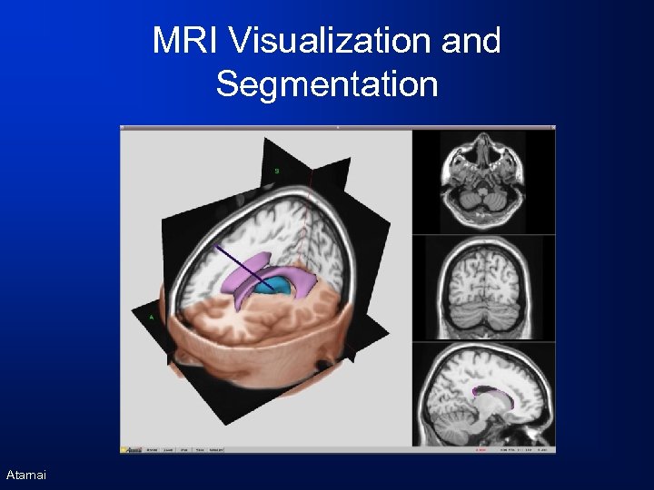 MRI Visualization and Segmentation Atamai 