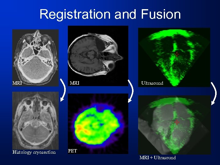 Registration and Fusion MRI Histology cryosection MRI Ultrasound PET MRI + Ultrasound 
