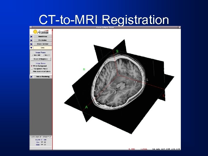 CT-to-MRI Registration 