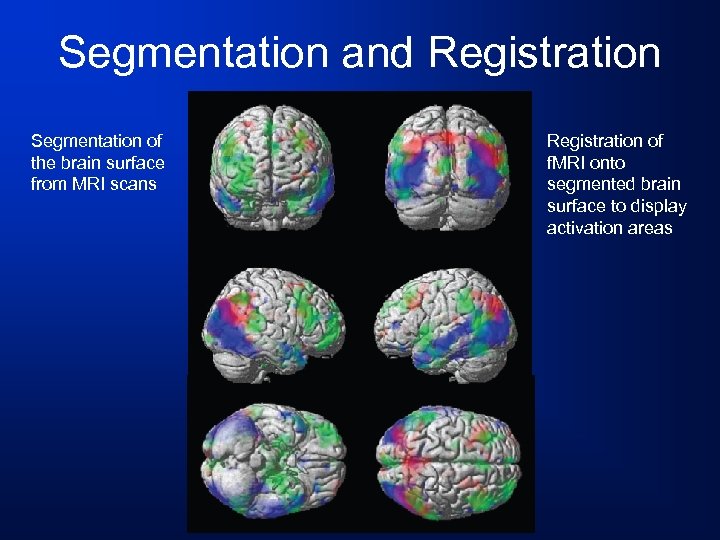 Segmentation and Registration Segmentation of the brain surface from MRI scans Registration of f.