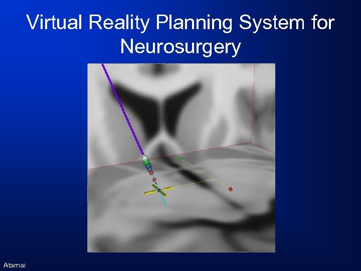 Virtual Reality Planning System for Neurosurgery Atamai 