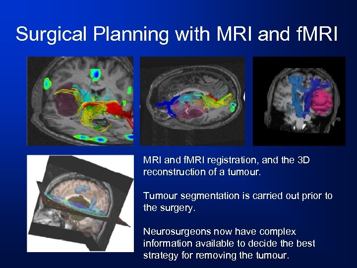 Surgical Planning with MRI and f. MRI registration, and the 3 D reconstruction of