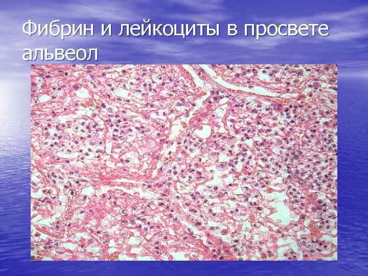 Фибрин и лейкоциты в просвете альвеол 